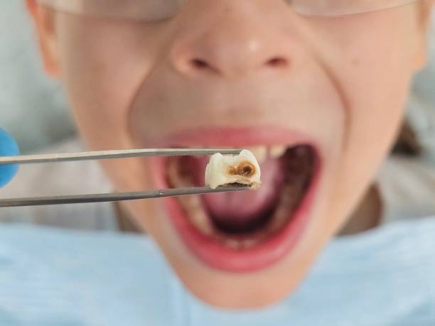 Best Emergency Treatment for Dental Infections or Abscesses in Leisure World, MD